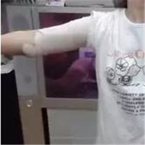 手臂吸脂手術(shù)八個(gè)月了，看看我的前后對(duì)比果圖片吧~~