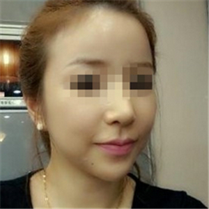 伊萊美做磨骨整形手術半年多了，分享下恢復過程照片哦~~~