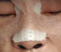 自體軟骨隆鼻手術(shù)果和恢復(fù)過(guò)程圖分享