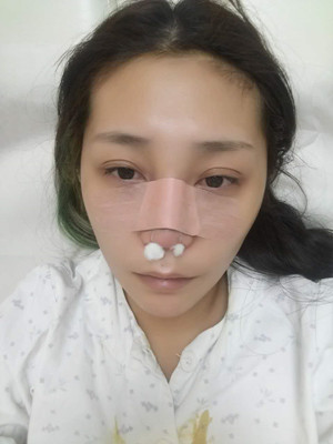 周長兵給我做的隆鼻整形恢復得好自然