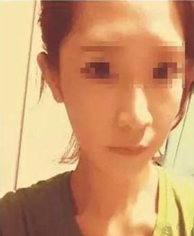 【20天康復(fù)記錄】隆鼻+面部脂肪填充，遇見更美的自己