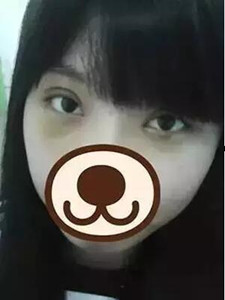 【真人案例】雙眼皮手術(shù)后，見證我的美!