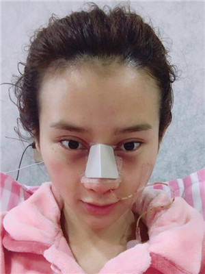 吳建明教授做的隆鼻整形 看起來還不錯(cuò)