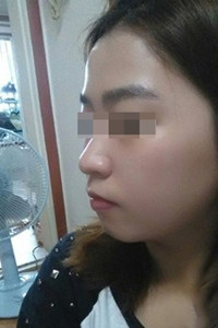 膨體隆鼻手術前后對比照片，真實案例分享！