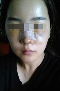 膨體隆鼻手術前后對比照片，真實案例分享！