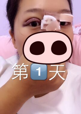 終于把雙眼皮割了，無錫菲尚張樹功做的