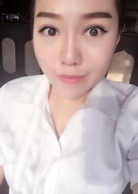 終于把雙眼皮割了，無錫菲尚張樹功做的