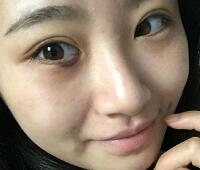 內(nèi)切去眼袋價格2180元，祛眼袋前后對比圖分享給大家