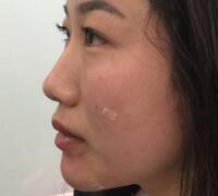 自體脂肪面部填充價格12800元案例