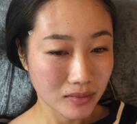 自體脂肪面部填充價格12800元案例