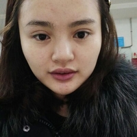 玻尿酸隆鼻花了兩萬多果很自然哦，值~！