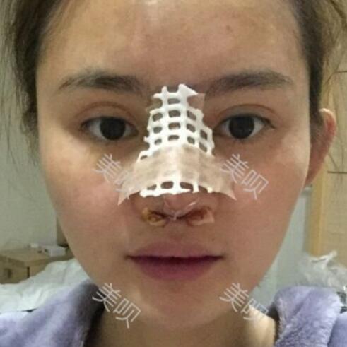 玻尿酸隆鼻花了兩萬多果很自然哦，值~！