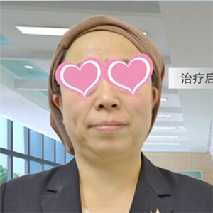 凱潤(rùn)婷做了水光補(bǔ)水，兩個(gè)月了，看看紅大媽的恢復(fù)果照片吧~