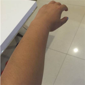 注射美白k氧注射針五次了，看看我的術(shù)后恢復果圖片吧~
