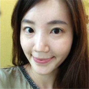 美女注射玻尿酸除皺過(guò)程分享，還有前后對(duì)比果圖片哦~