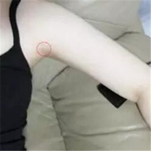 做了吸脂瘦手臂四個(gè)月，果很自然，有恢復(fù)前后對(duì)比果圖片哦~