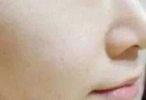 白瓷娃娃緩解一次后,皮膚能直觀看出來水潤白皙緊致了一些