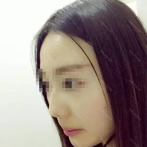 去年做了自體耳軟骨隆鼻手術(shù)，看看我的恢復(fù)過(guò)程照片，前后變化大~