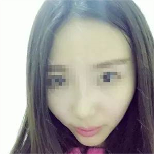 去年做了自體耳軟骨隆鼻手術(shù)，看看我的恢復(fù)過(guò)程照片，前后變化大~