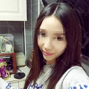 去年做了自體耳軟骨隆鼻手術(shù)，看看我的恢復(fù)過(guò)程照片，前后變化大~