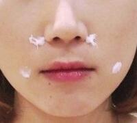 注射玻尿酸除皺價(jià)格3600元，術(shù)后果分享