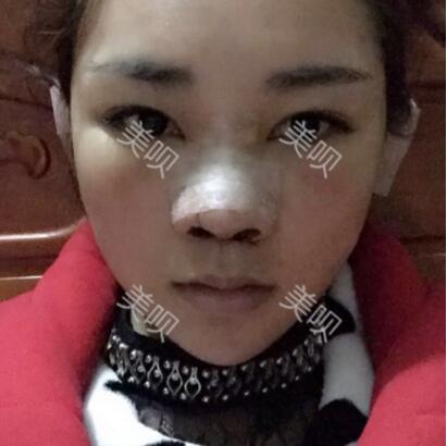 給大家分享在長沙鵬愛做的膨體隆鼻近一個月的恢復(fù)過程