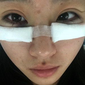 祛眼袋半年了，曬曬我的恢復(fù)前后對(duì)比果圖片哦