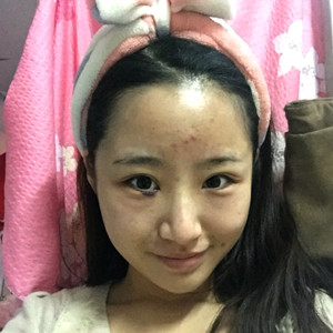 祛眼袋半年了，曬曬我的恢復(fù)前后對(duì)比果圖片哦