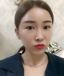 愛(ài)悅麗格玻尿酸豐蘋果肌、豐下巴、隆鼻