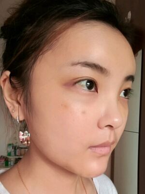 自體脂肪面部填充之后飽滿又自然，廣州曙光劉永波做噠