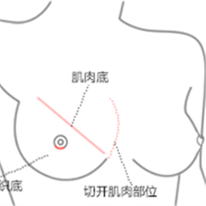 老媽隆胸失敗假體取出，還是自然點(diǎn)好~