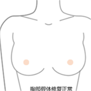 老媽隆胸失敗假體取出，還是自然點好~