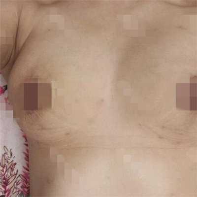 去年做的乳房下垂矯正手術，恢復照片給你們看看呢~