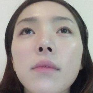 玻尿酸注射豐額頭前后對比果圖片分享，銅雀臺做的哦~
