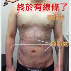 吸脂減肥手術瘦身，也算一個正能量胖子逆襲的故事吧
