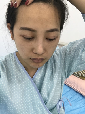自體脂肪隆眉弓后，更有精神了