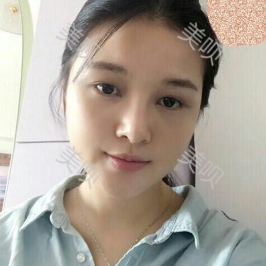 玻尿酸隆鼻改變了大鼻翼給大家分享下我的恢復(fù)過(guò)程