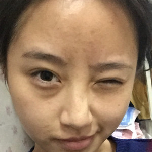 做了玻尿酸隆眉弓，感覺(jué)棒棒噠