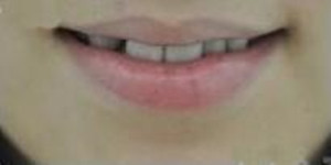做了美容冠矯正 現(xiàn)在我的牙齒整齊又漂亮