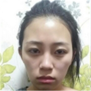 自體脂肪面部填充一年了，分享我的恢復(fù)過程，有前后對比照片哦~