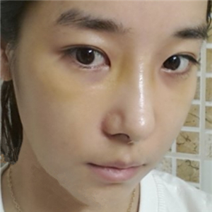 廣州博仕做了隆鼻整形半年了，分享恢復(fù)過程和前后對比果照片哦~