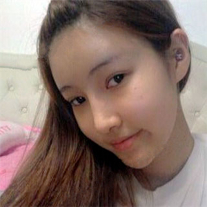 去年做了隆鼻整形，分享恢復(fù)過(guò)程和前后對(duì)比果圖片哦，