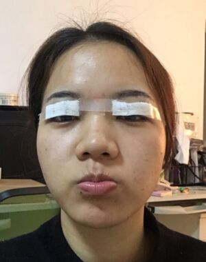 為了美麗大眼做了切開雙眼皮，果令我驚嘆