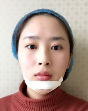 深圳美萊整形醫(yī)院做了進口硅膠墊下巴臉型都變好看了