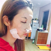 去年做的鷹鉤鼻矯正+面部脂肪填充，分享術(shù)后照片~