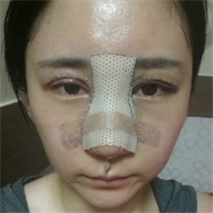 埋線雙眼皮+隆鼻手術(shù)恢復過程和前后對比果圖片真實分享~~~