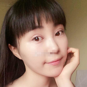 開外眼角手術一個月了，分享恢復過程和前后對比果照片~