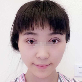 開外眼角手術(shù)一個(gè)月了，分享恢復(fù)過程和前后對比果照片~