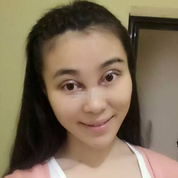 開外眼角手術一個月了，分享恢復過程和前后對比果照片~