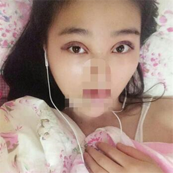 開外眼角手術一個月了，分享恢復過程和前后對比果照片~
